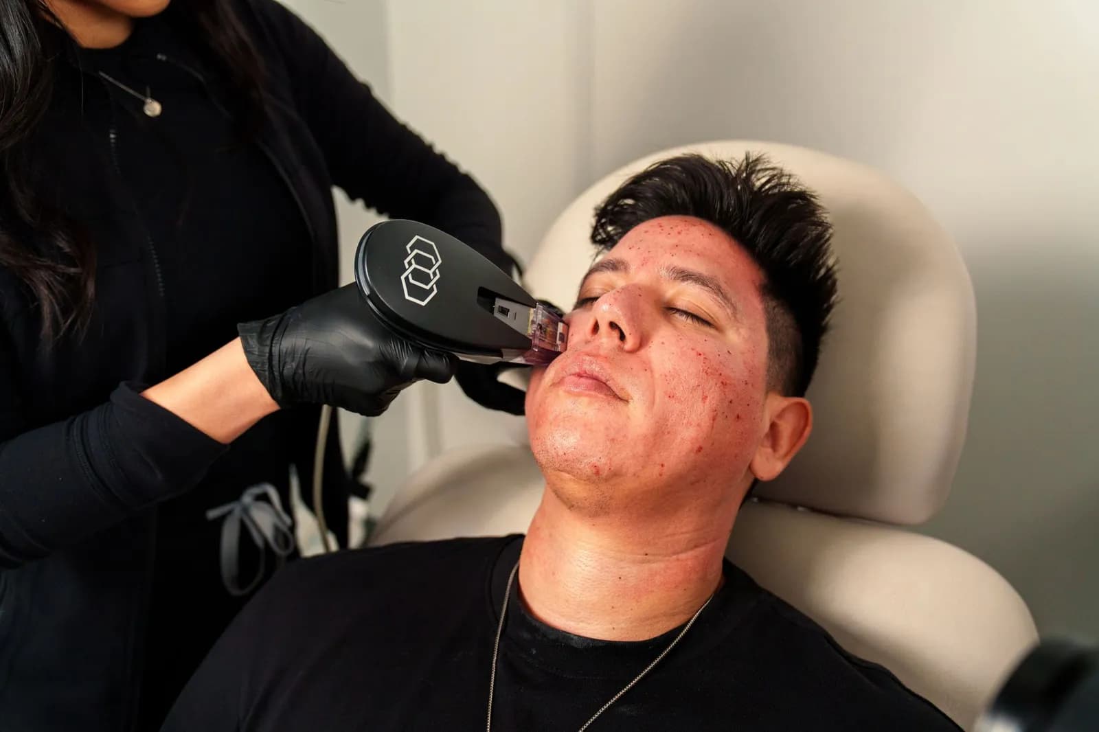Man receives Morpheus8 facial treatment in Santa Ana med spa for skincare rejuvenation.